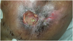 Infected bed pressure wound with necrosis after treatment, granilization tissue formation with topivac