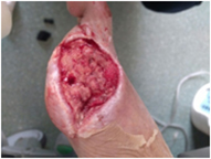 Post-treatment knee trauma implant fracture wound healing