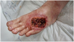 diabetic foot: infection and necrotic sugar wound, debrided wound