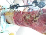 Traumatic Wound Fixator After Traffic Accident