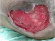 Pressure Infected Tunnel Wound After Treatment With Granulation