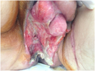 Penis and Testicle Infected Traumatic Wound After Treatment