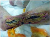 Infected Venous Stasis Ulcerated Foot Wound