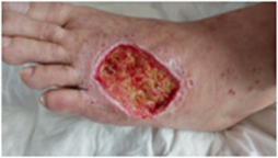 diabetic foot: infection and necrotic sugar wound, granulation of debrided wound, wound healing