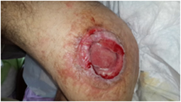 Knee trauma, implant fracture wound